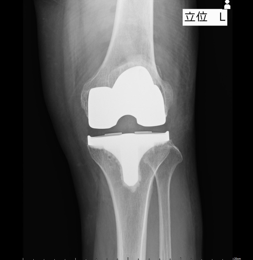 人工膝関節置換術（TKA）1