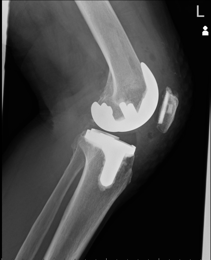 人工膝関節置換術（TKA）2